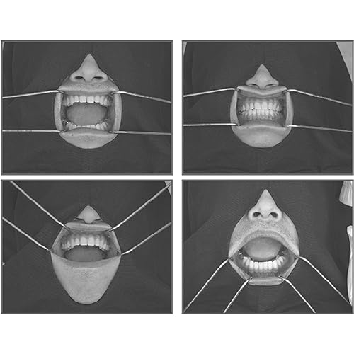 OSUNG Dental Columbia Cheek Retractor Autoclavable Mouth Opener Stainless Steel Instrument Teeth Whitening RTCRC 2 pc set - Poueer