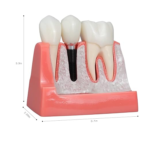 ANNWAN Dental Implant Model 4 Times Removable Analysis Crown Bridge Demonstration Teeth Model for Class Education and Studying Teeth Model - Poueer