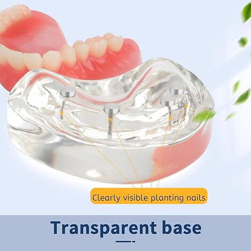 Upper Overdenture Model - Dental Implant Overdenture Model,Denture Model with Implants for Teaching and Studying - Poueer