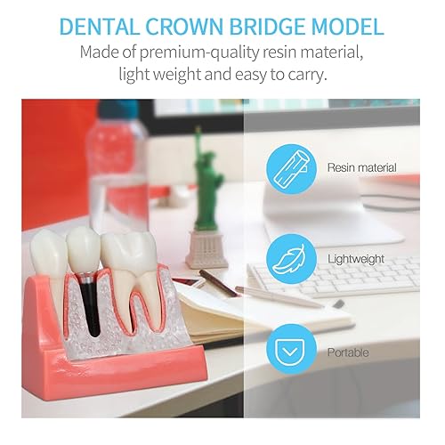 ANNWAN Dental Implant Model 4 Times Removable Analysis Crown Bridge Demonstration Teeth Model for Class Education and Studying Teeth Model - Poueer