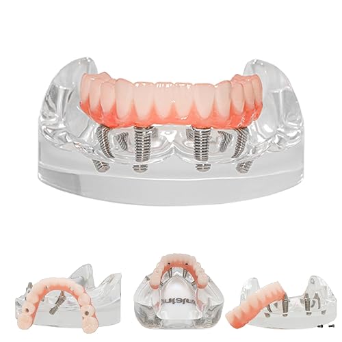 Dental Typodont Implant Transparent Model, Lower Jaw Type, Removable All-on-4 Restoration Overdenture, with 4 Implants (Lower Jaw -M6027) - Poueer