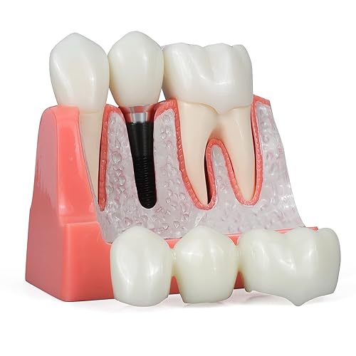 ANNWAN Dental Implant Model 4 Times Removable Analysis Crown Bridge Demonstration Teeth Model for Class Education and Studying Teeth Model - Poueer