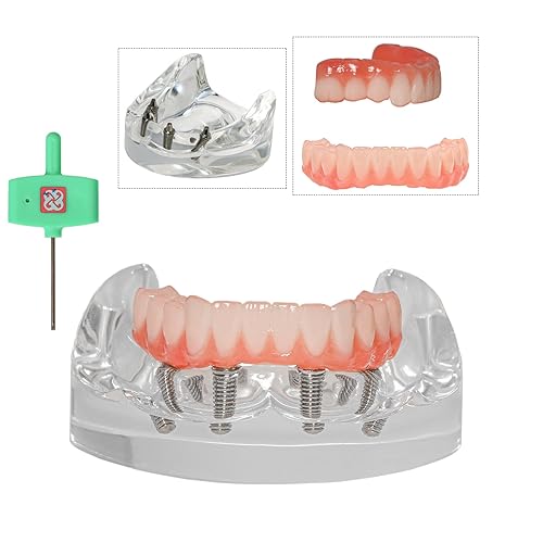 Dental Typodont Implant Transparent Model, Lower Jaw Type, Removable All-on-4 Restoration Overdenture, with 4 Implants (Lower Jaw -M6027) - Poueer