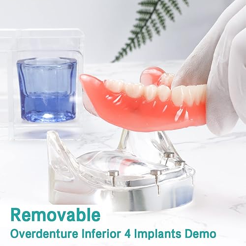 Dental Overdenture Inferior Model - Dental Implants Demo Model 4 Nail Dental Implant Model for Education and Communication - Poueer