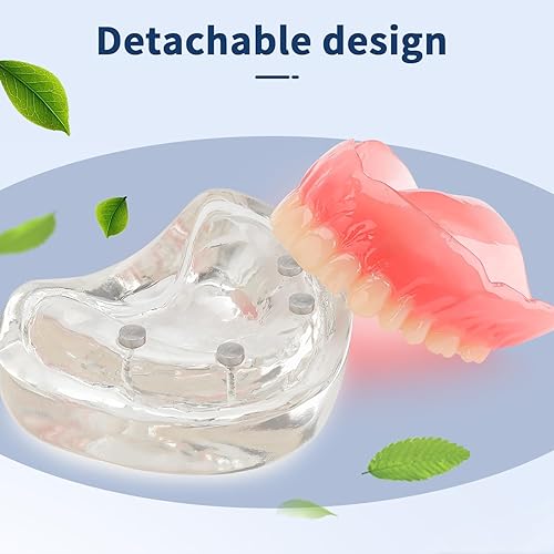 Upper Overdenture Model - Dental Implant Overdenture Model,Denture Model with Implants for Teaching and Studying - Poueer