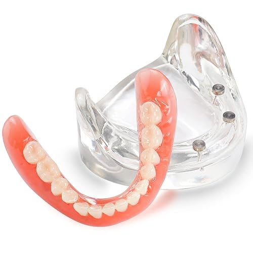 Dental Overdenture Inferior Model - Dental Implants Demo Model 4 Nail Dental Implant Model for Education and Communication - Poueer
