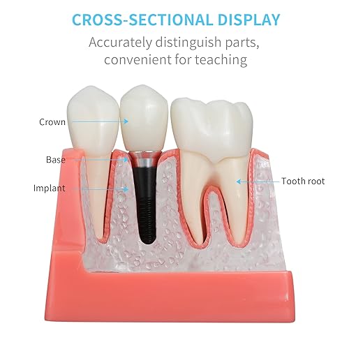ANNWAN Dental Implant Model 4 Times Removable Analysis Crown Bridge Demonstration Teeth Model for Class Education and Studying Teeth Model - Poueer