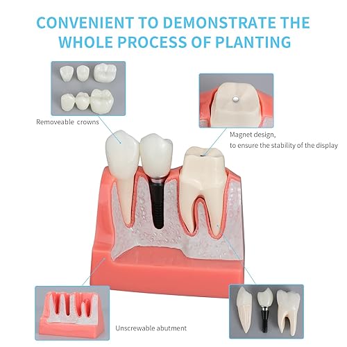 ANNWAN Dental Implant Model 4 Times Removable Analysis Crown Bridge Demonstration Teeth Model for Class Education and Studying Teeth Model - Poueer